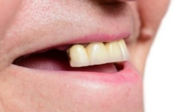 Petition : Pour le remboursement de tous les soins dentaires en France (bridges, implants réservés aux riches)