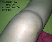 Pétition Algoneurodystrophie ou SDRC maladie anodine ?