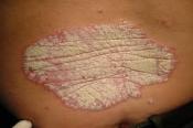 Reconnaissance du Psoriasis , comme un handicap de la peau