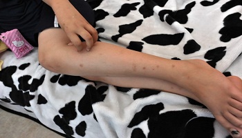 La désinsectisation des punaises de lit