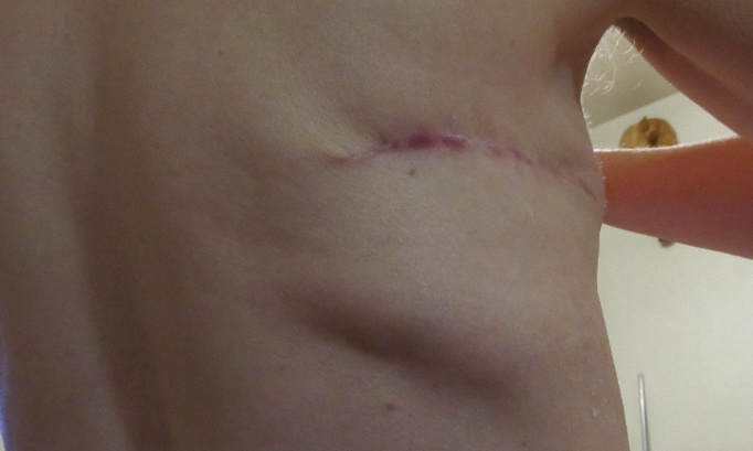 STOP A LA RECONTRUCTION MAMMAIRE PAR GRAND LAMBEAU DORSAL. STOP A LA PRODUCTION D