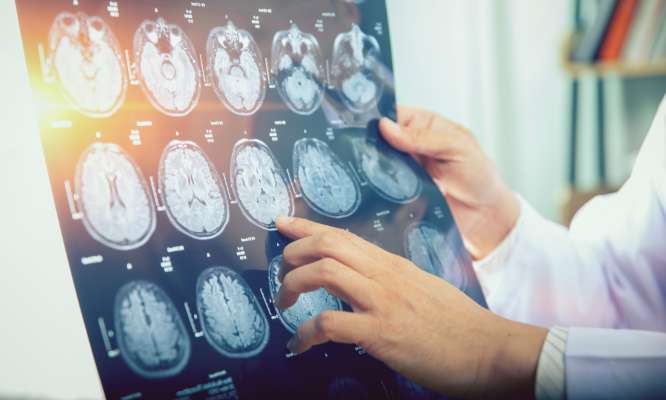 Effets du Covid sur le cerveau : pour des analyses neurologiques rembours&eacute;es