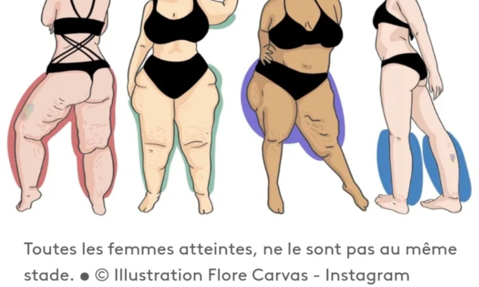 Abonnissez le diagnostic du Lipoedeme : offrez nous une prise en charge !