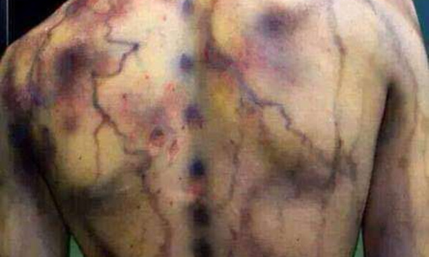 Reconnaissance de la Fibromyalgie en France, cette maladie invisible mais invalidante.