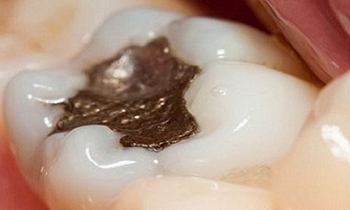 Pour l'interdiction des amalgames dentaires