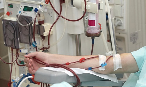 Réfection de l'accès à l'hémodialyse