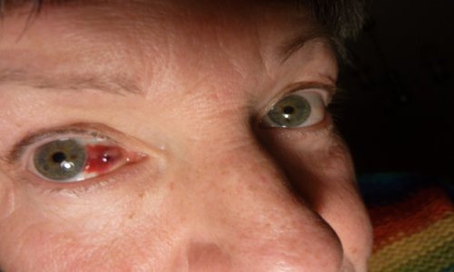 Création d'une zone blanche en Bretagne #OndeElectromagnétique