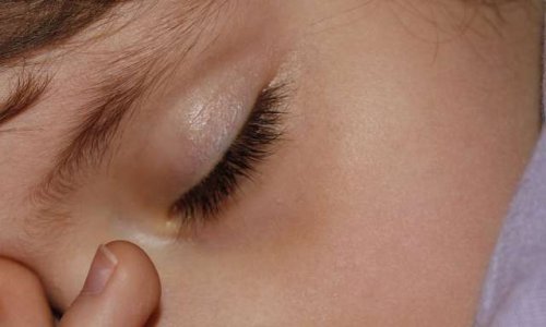 Contre le déremboursement de la Mélatonine en préparation magistrale qui permet aux enfants autistes entre autre de DORMIR