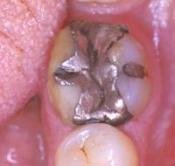 Stoppons immédiatement l'utilisation du Mercure dentaire qui est néfaste à notre santé  et à notre environnement