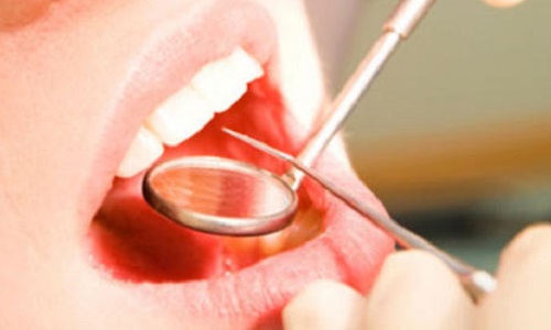 Avez-vous des amalgames au mercure (plombages) dans la bouche?